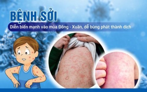 BÀI TRUYÊN TRUYỀN PHÒNG CHỐNG BỆNH SỞI